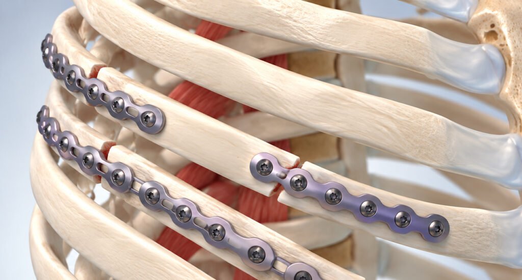 When Is Rib Plating Necessary for Fractured Ribs?