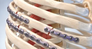 When Is Rib Plating Necessary for Fractured Ribs?